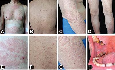 Case report: Successful treatment of non-bullous lichen planus pemphigoides with dupilumab